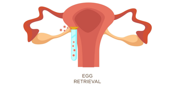 Egg retrieval procedure at Sattva Fertility Care Center