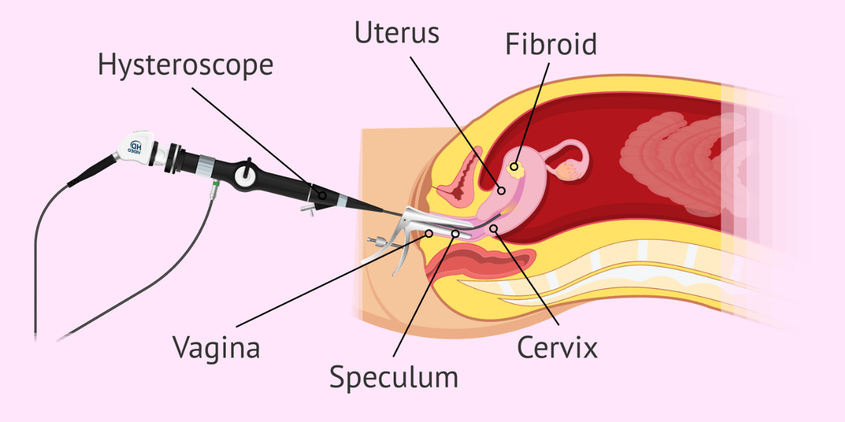 Hysteroscopy and laparoscopy surgery consultation at Sattva Fertility Care Center