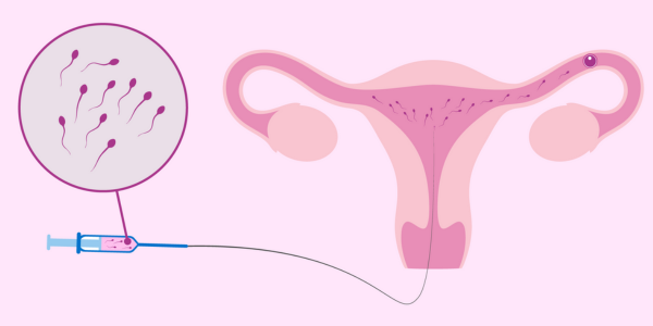 IUI insemination procedure at Sattva Fertility Care Center