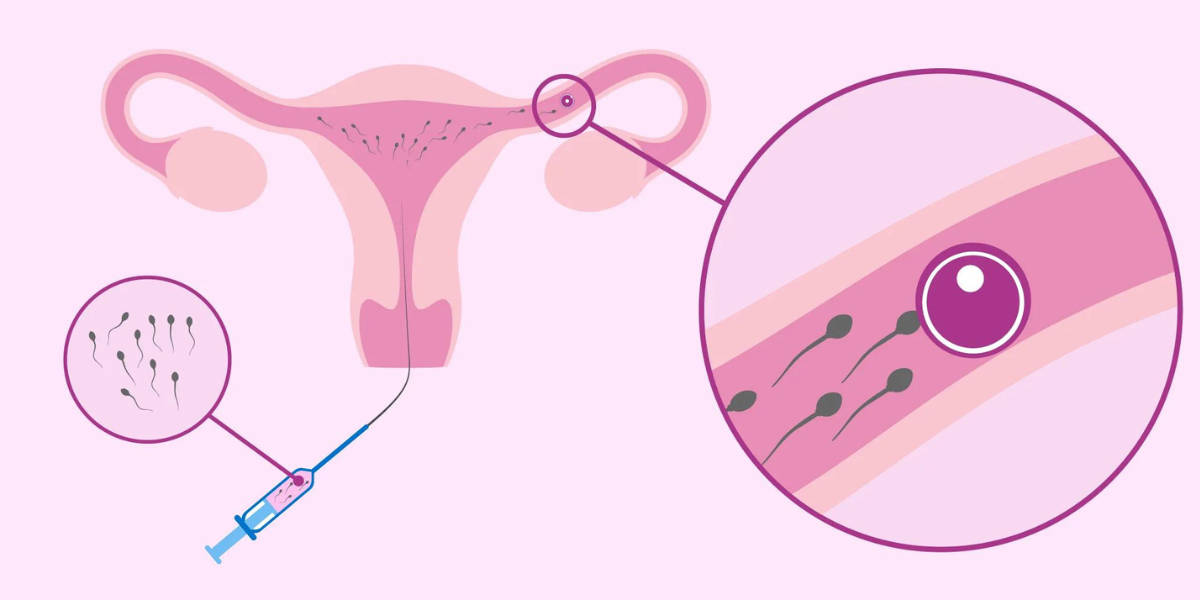 IUI treatment consultation at Sattva Fertility Care Center