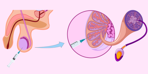 Sperm retrieval procedure at Sattva Fertility Care Center